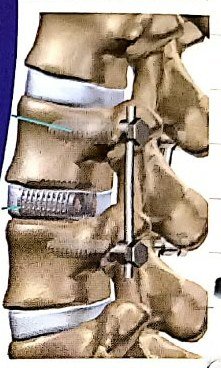 Spinal fusion