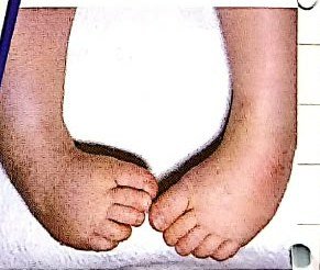 Clubfoot in a child