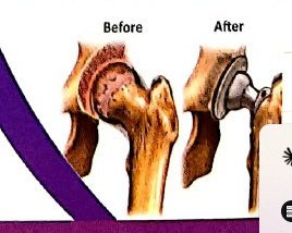Hip replacement