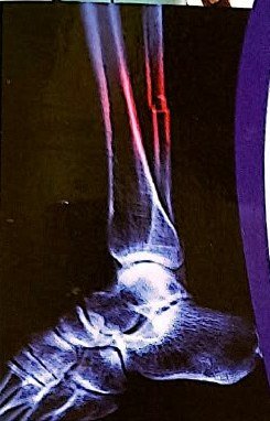 Ankle X-ray showing a fracture