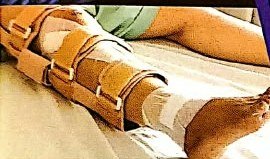 Leg splint