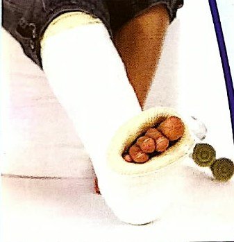 Plaster cast